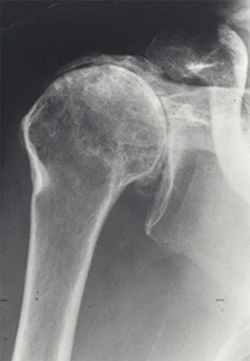 Advanced shoulder osteoarthritis X-ray showing joint destruction