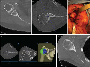 CT scan multi-panel pre-operative planning for shoulder replacement including 3D reconstruction