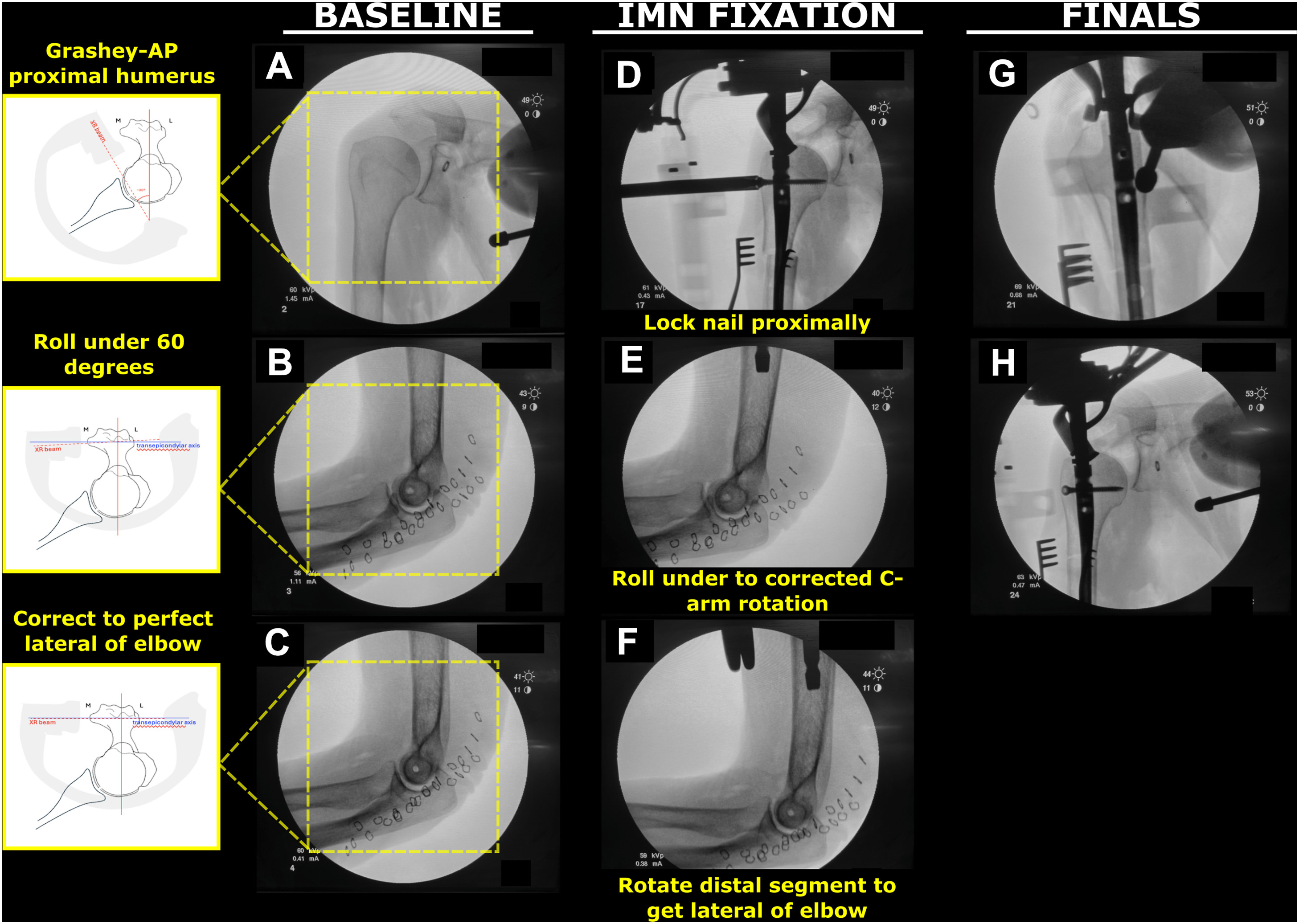 Intraoperative C-arm fluoroscopy panels confirming shoulder implant position and alignment