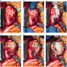 Intraoperative 6-panel view of deltopectoral approach for shoulder replacement