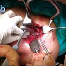 Intraoperative view of glenoid preparation during shoulder replacement surgery