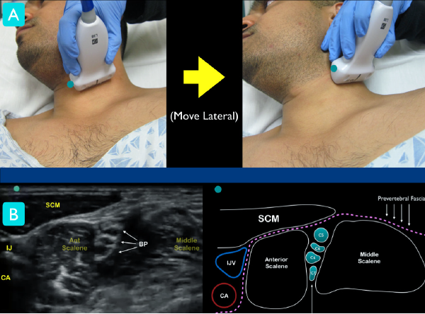 Ultrasound-guided interscalene brachial plexus nerve block for shoulder surgery
