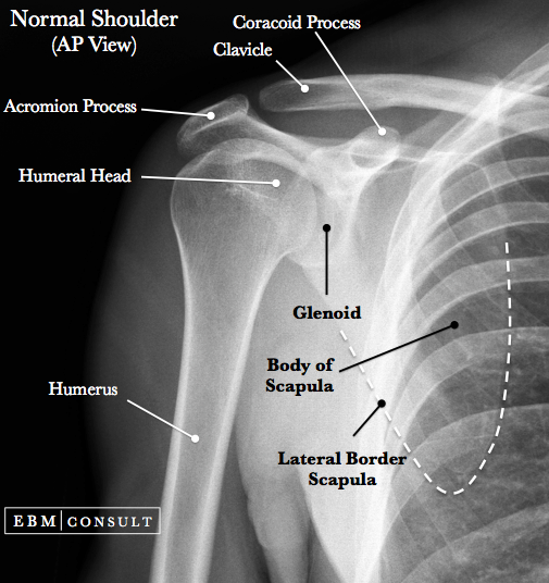 Normal shoulder joint X-ray AP view with anatomical labels