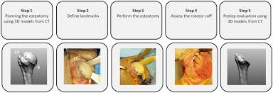5-step humeral head osteotomy workflow using 3D CT models