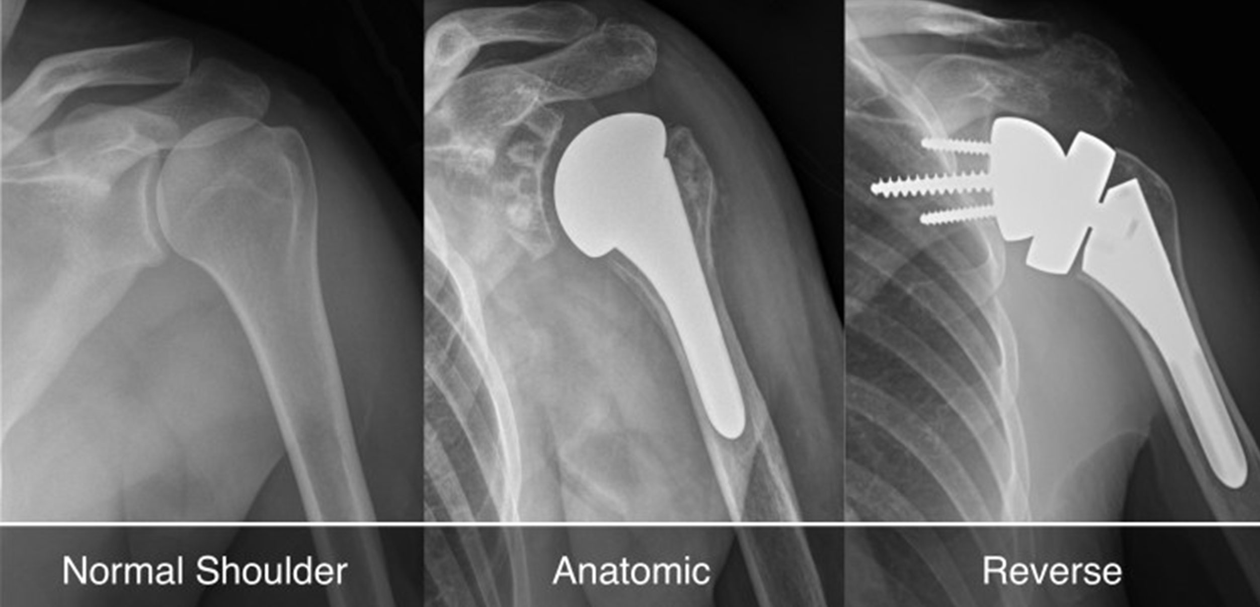 X-ray comparison of normal shoulder, anatomic TSA, and reverse TSA (RTSA)