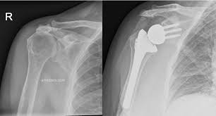Before and after X-ray comparison — arthritic shoulder vs post-op total shoulder arthroplasty