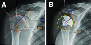 Pre-operative shoulder X-ray with implant sizing measurement overlays